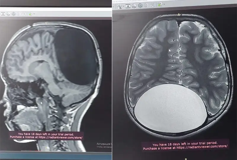 奇姆肯特医生成功为小患者取出脑内寄生虫