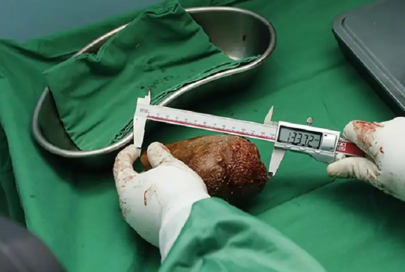 Самый большой в мире камень в почках удален в Шри-Ланке