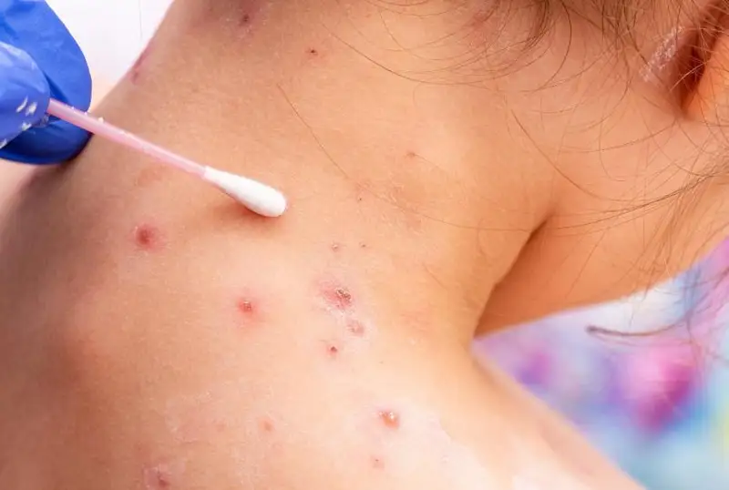 س ق و-دا جەلشەشەك جۇقتىرعاندار سانى ءۇش ەسە ارتتى