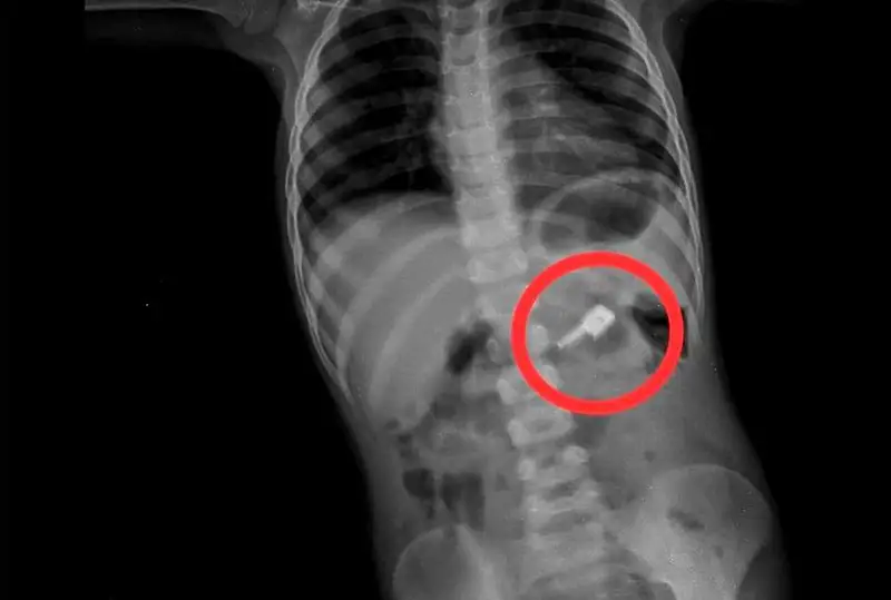 Таразские врачи спасли ребенка, проглотившего швейные иглы