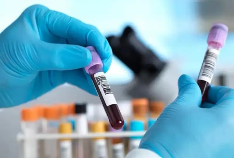 Британиялик олимлар қон таҳлили орқали саратонни аниқлашнинг янги усулини ихтиро қилди