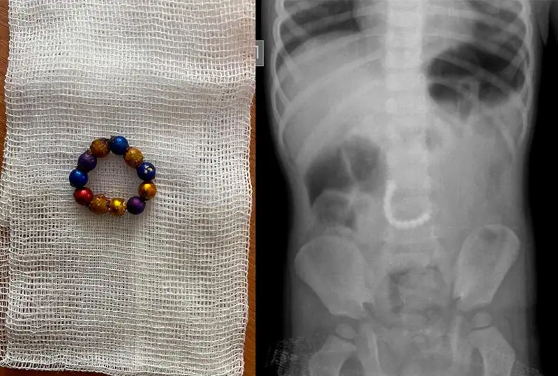 Врачи спасли проглотившего 11 магнитов мальчика в Караганде