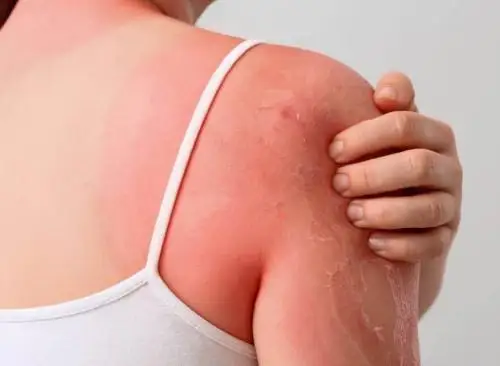 كۇن ساۋلەسى ادام تەرىسىنە تەرىس اسەر ەتەدى - عالىمدار