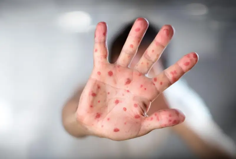 80% детей переносят корь легко - врач