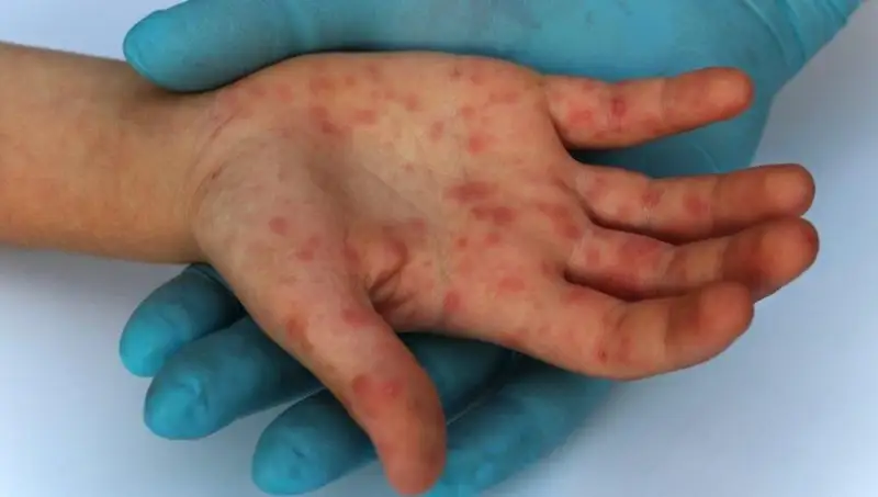 قازاقستاندىقتارعا قىزىلشا دەرتىن جۇقتىرۋ قاۋپى بار ەكەنى ەسكەرتىلدى