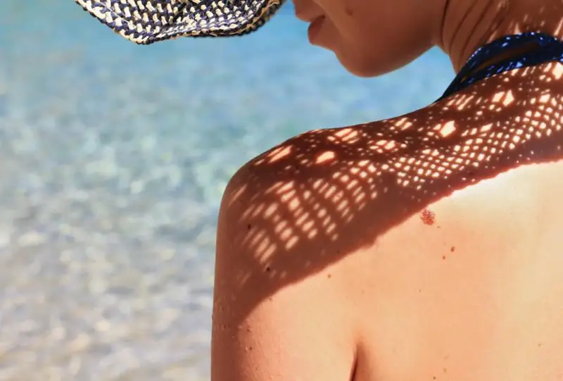 Jerorta teńizi jaǵalaýynda kúnge qyzdyrynýdy unatatyndar melanomaǵa beıim keledi - onkolog