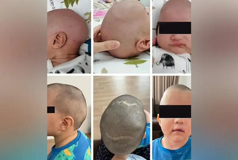 Almaty dárigerleri bas súıeginde týabitti aqaýy bar nárestege ota jasady