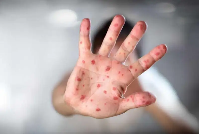 Ўтган йили дунёда 150 мингдан ортиқ одам қизамиқ билан касалланган