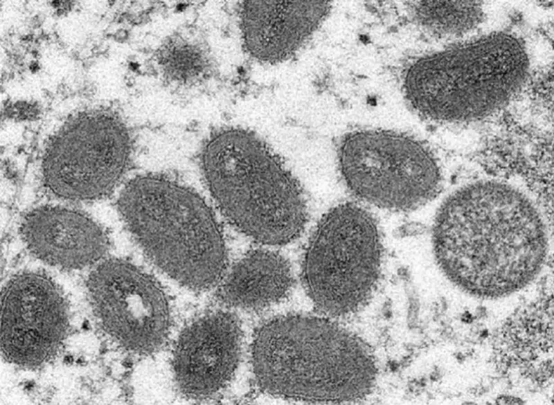 Ваҳимага ҳеч қандай асос йўқ - Бельгия вирусологлари маймун чечаги ҳақида