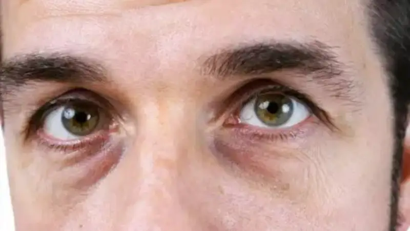 كوزدىڭ استى قارا بولۋى نە بىلدىرەدى؟ دەرماتولوگ ەسكەرتۋ جاسادى