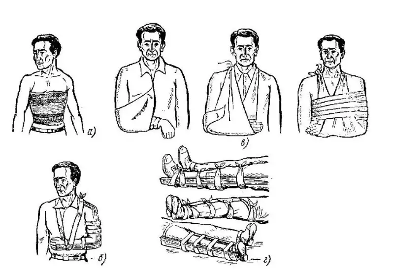 قازاق ەمشىلىگى: سىنعان سۇيەكتى وتاسىز ورنىنا سالۋ