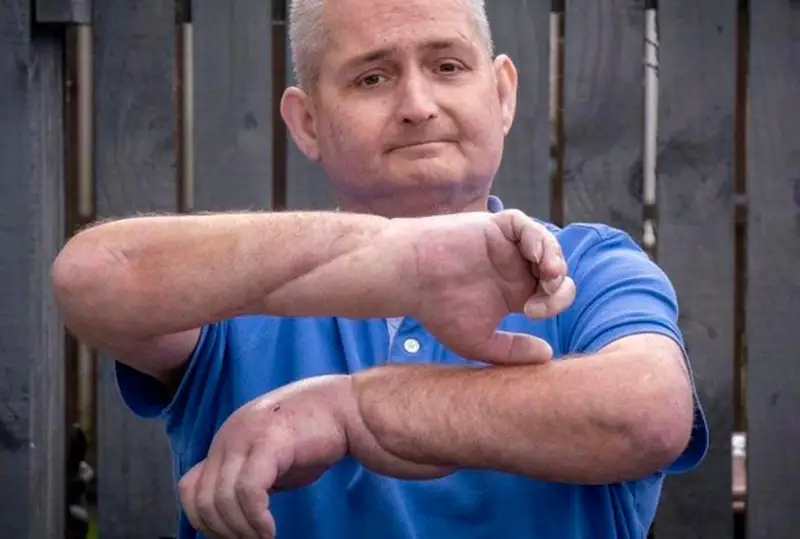 دارىگەرلەر ناۋقاس ازاماتتىڭ ەكى قولىن اۋىستىرىپ سالعان