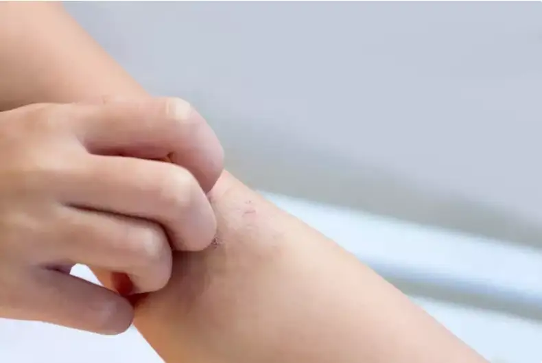 قازاق حالقى تەرى اۋرۋىن قالاي ەمدەگەن؟