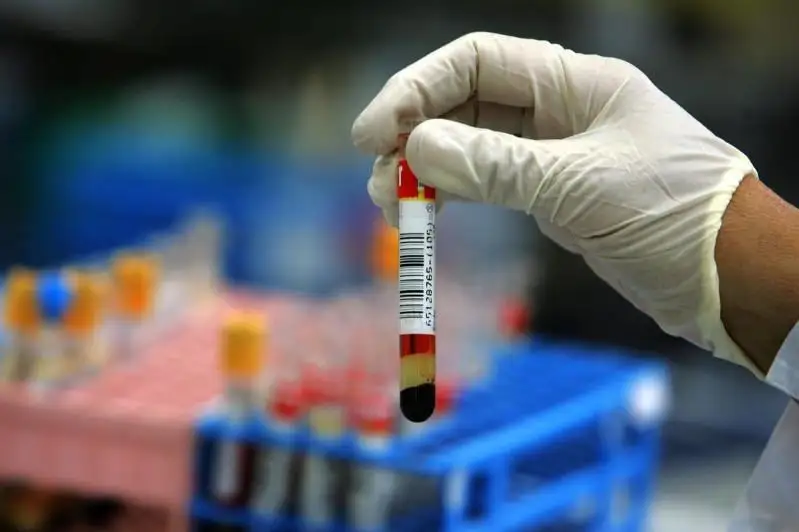 Филиппинда бир кунда 15 мингга яқин одам коронавирус юқтирган