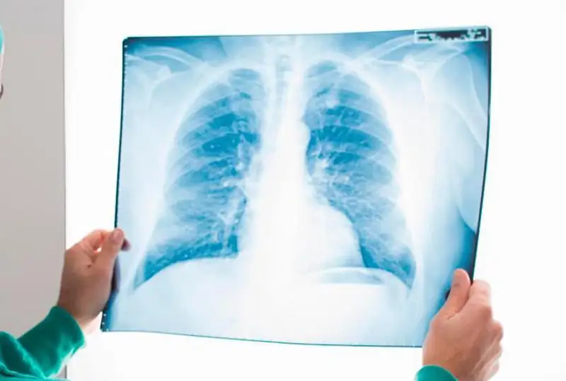 Ковидной пневмонией за сутки заболели три человека в Казахстане