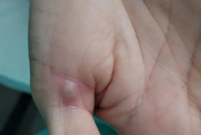 Маймун чечаги билан касалланганлар сони бундан ҳам кўп бўлиши мумкин - ЖССТ