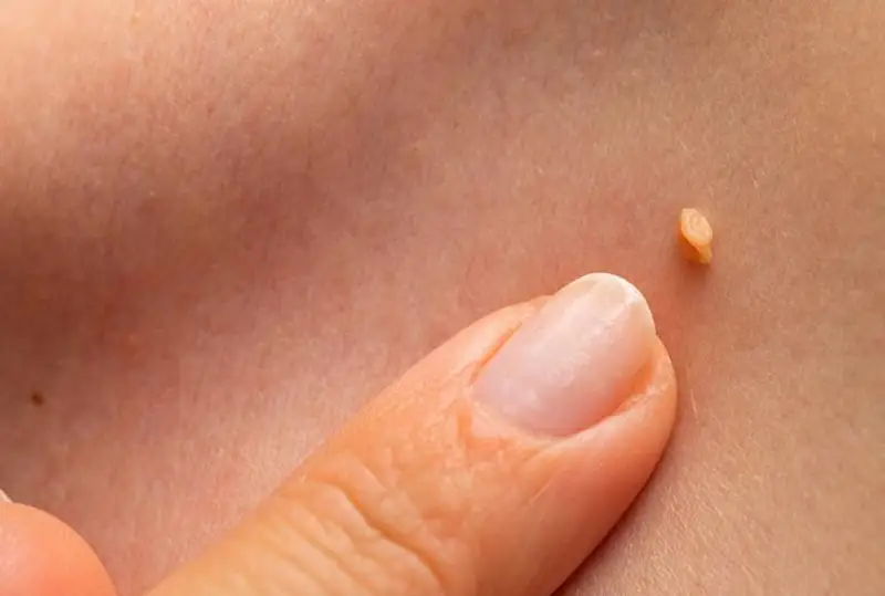 Теридаги сўгал ва папилломалар саратонга олиб келиши мумкин