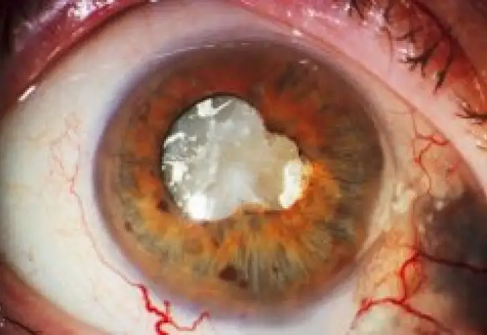 عالىمدار ادامدى تۇڭعىش رەت انابيوز حالىنە كەلتىردى