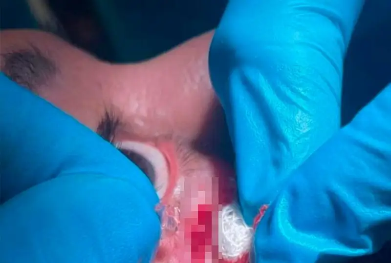 Aqtaýda dáriger naýqastyń betinde 25 jyl turǵan áınek synyǵyn alyp tastady