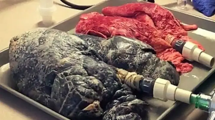 دارىگەرلەر 30 جىل تەمەكى شەككەن ادامنىڭ وكپەسى قالاي وزگەرەتىنىن كورسەتتى