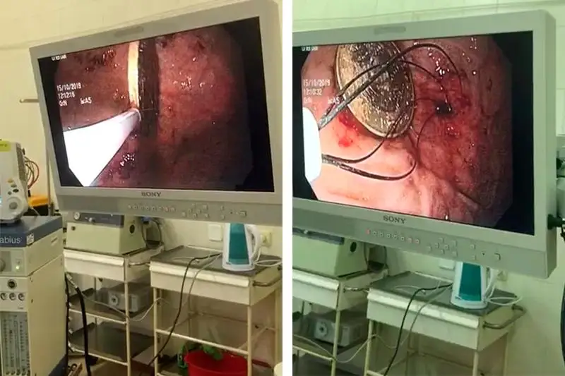 الماتىدا دارىگەرلەر التى جاسار بالانىڭ اسقازانىنان 100 تەڭگەلىك مونەتا الدى