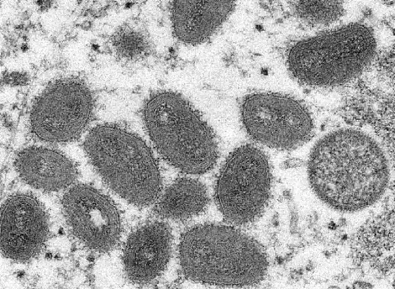 Случаи оспы обезьян зафиксировали в Европе