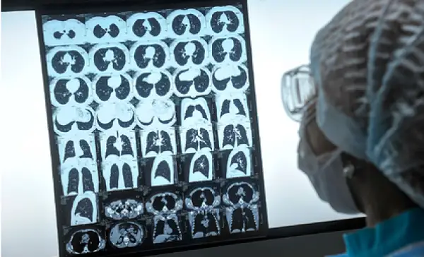 تەمەكى شەگەتىن ادامداردا كوروناۆيرۋستىڭ اسقىنۋ قاۋپى 14 ەسە جوعارى بولادى - زەرتتەۋ