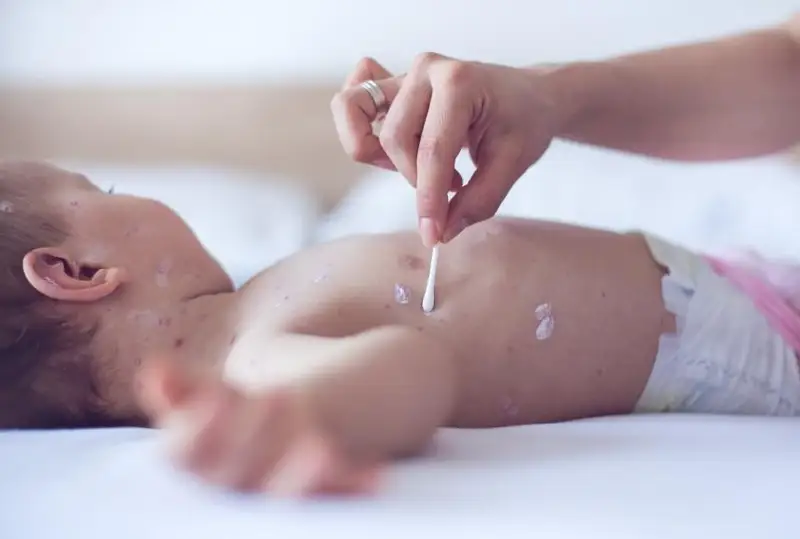 Рост заболеваемости ветряной оспой отмечается в Кыргызстане