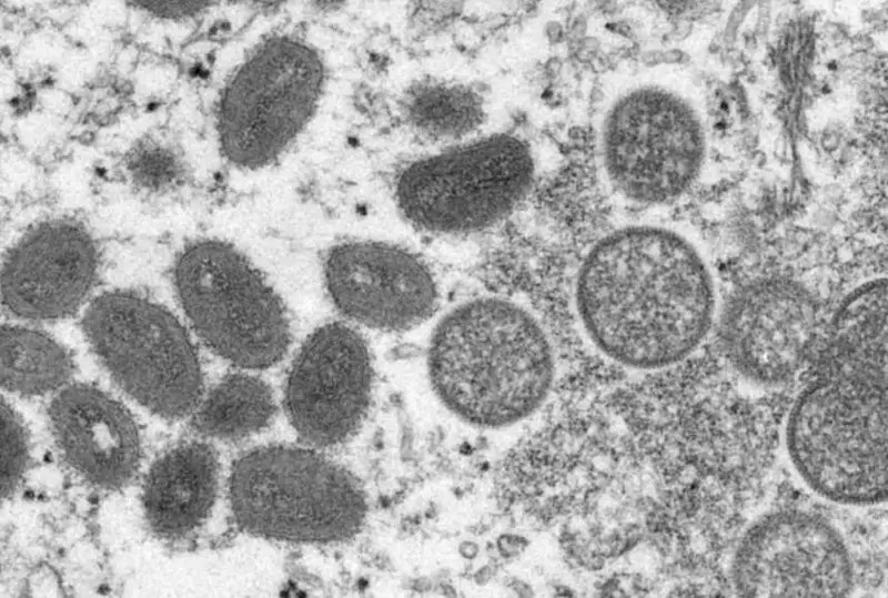 Первый случай заболевания оспой обезьян выявили в Японии