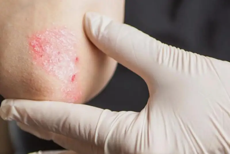 Дорогостоящее лечение псориаза получают бесплатно 140 карагандинцев