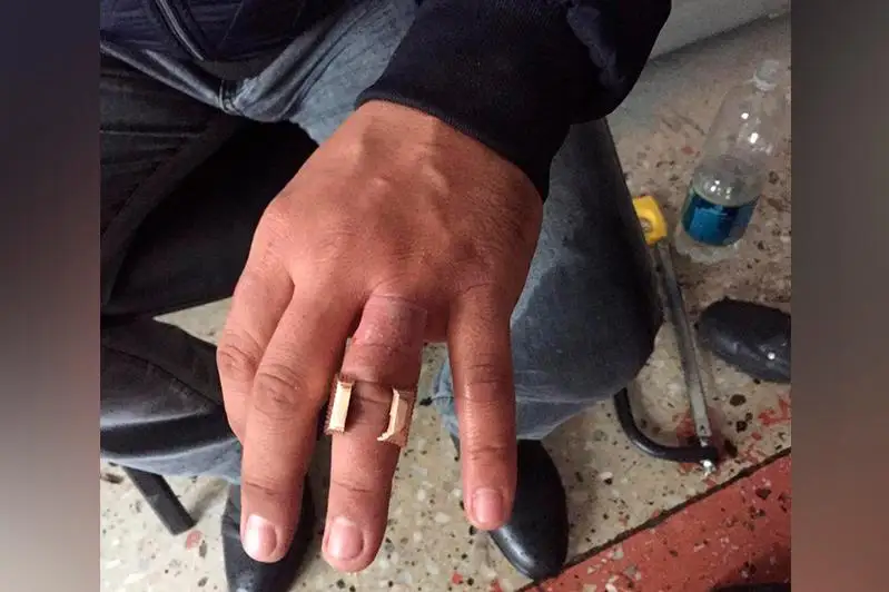 Спасателям пришлось снимать кольцо с опухшего пальца костанайца