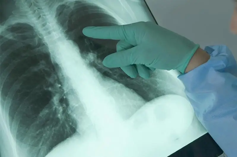 588 случаев пневмонии с признаками КВИ зафиксировано в Казахстане