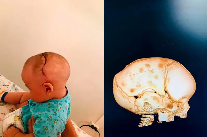 Ребёнка с врожденной патологией головы прооперировали в Атырау