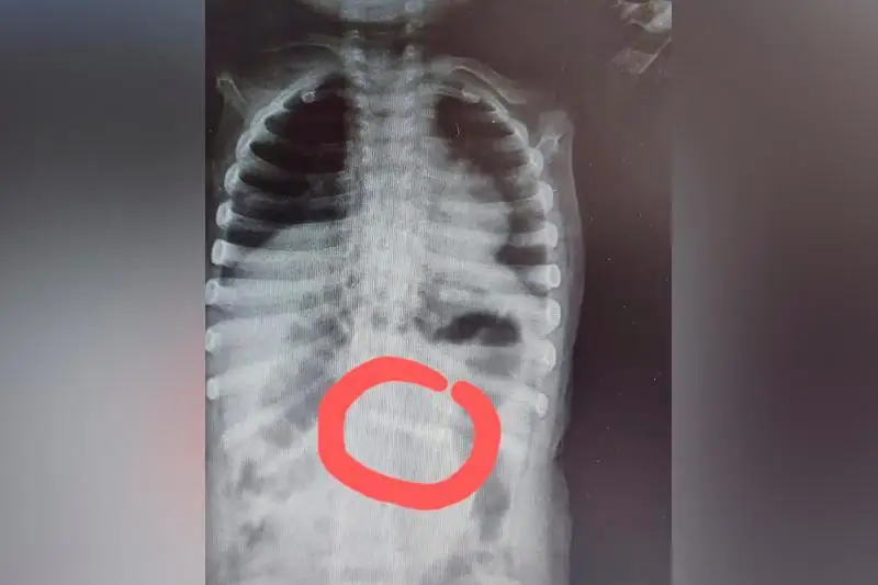 Годовалый малыш проглотил ключ – врачи спасли маленького пациента в Таразе