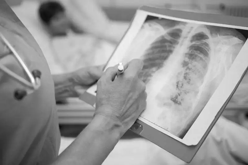 70 казахстанцев заболели пневмонией, двое скончались