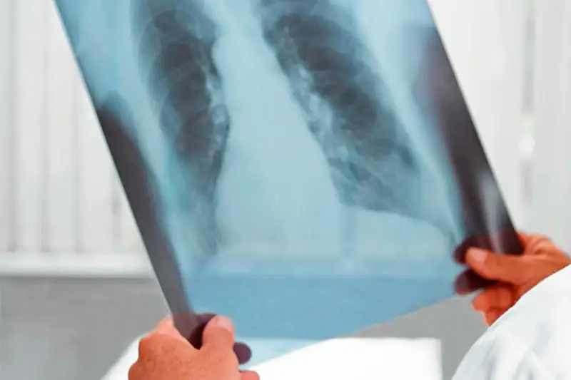 80% пациентов с раком легкого обращаются к врачам с запущенной формой в Казахстане
