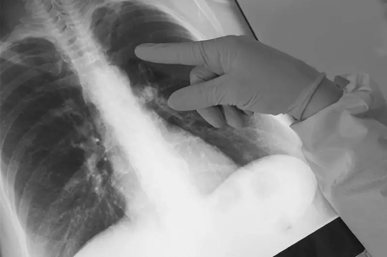 Четыре человека скончались от пневмонии с признаками коронавируса в Казахстане