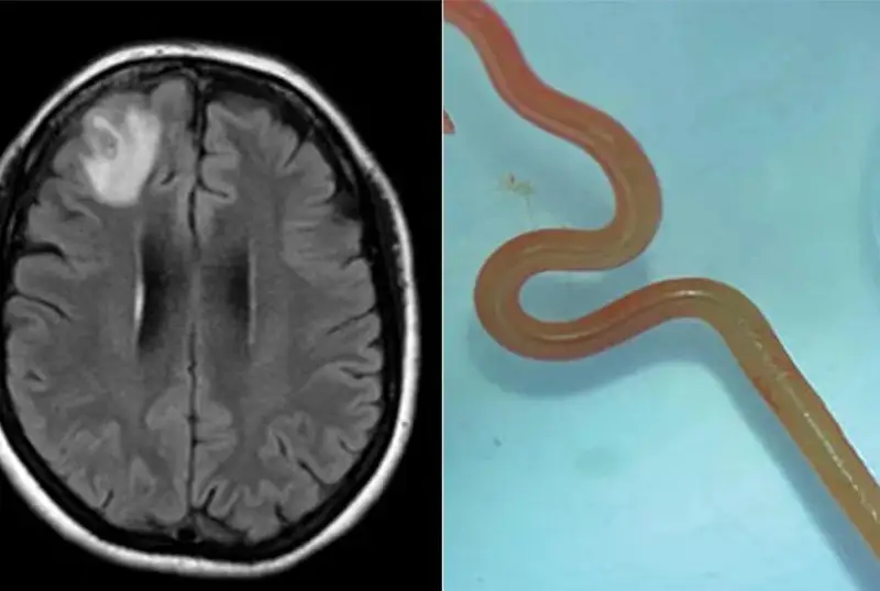 Шифокорлар дунёда биринчи марта беморнинг миясида тирик чувалчангни топишди