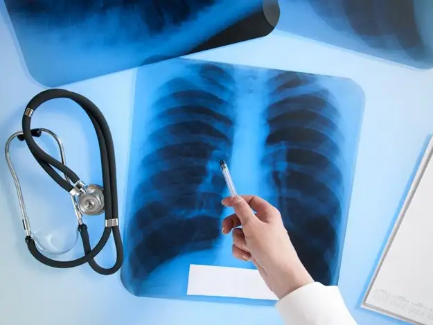 Aqmola oblysynda 2 qańǵybas adamnan týberkýlezdiń ashyq túri anyqtaldy