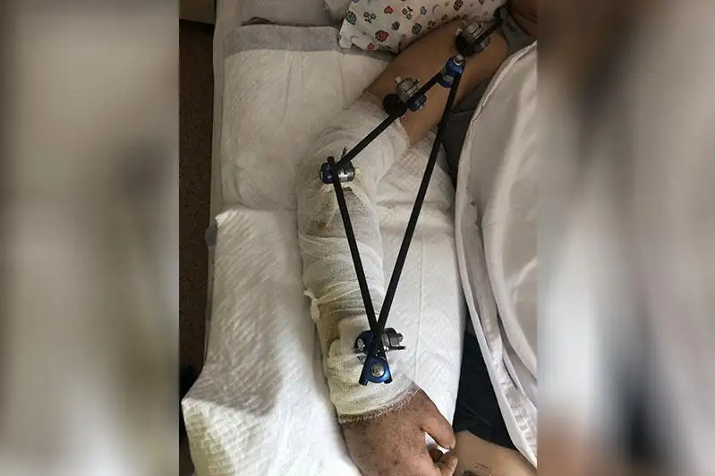 Shymkent dárigerleri qolynyń súıegi úgitilip ketken jigitke kúrdeli ota jasady