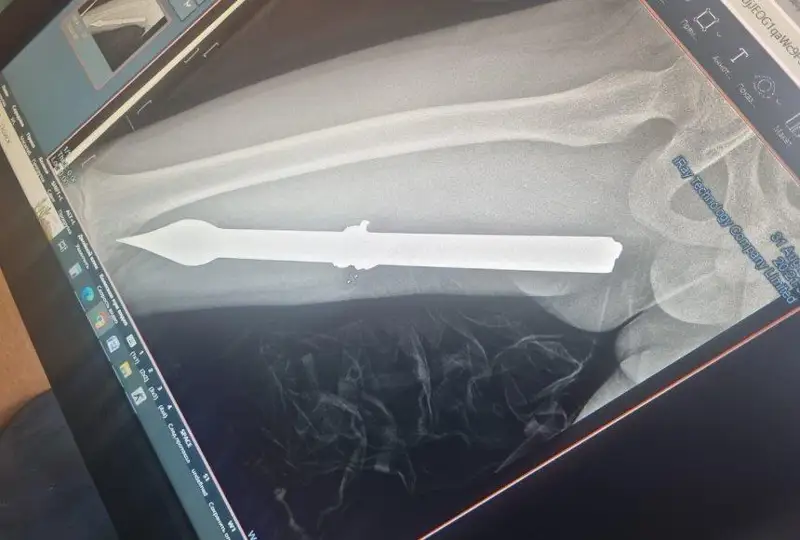 Мальчик проткнул ногу штырем от забора в Алматы