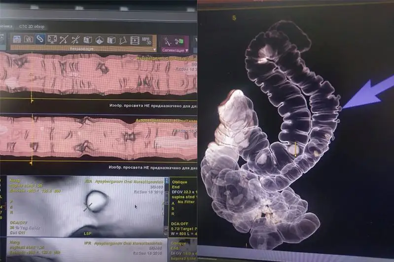 Виртуальную эндоскопию проводят в больнице СКО