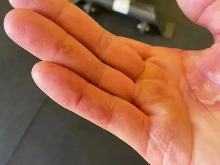 «Ковидные пальцы»: нетипичный для коронавируса симптом обнаружили ученые