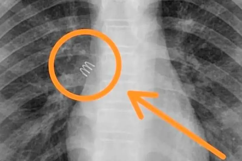 Пружину удалили из бронхов 11-летней девочки в Актау