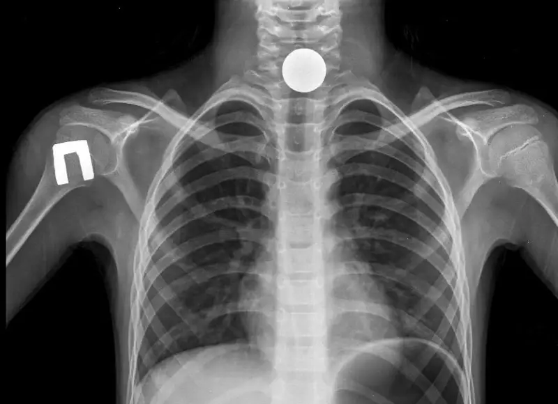 9-летнего мальчика, проглотившего монету, спасли в Таразе