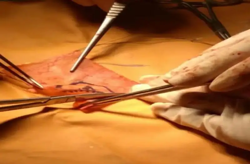 Первая в Казахстане и Центральной Азии: уникальную операцию провели мангистауские кардиохирурги