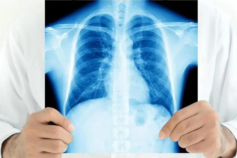 Заболеваемость туберкулезом среди детей снизилась в Северо-Казахстанской области