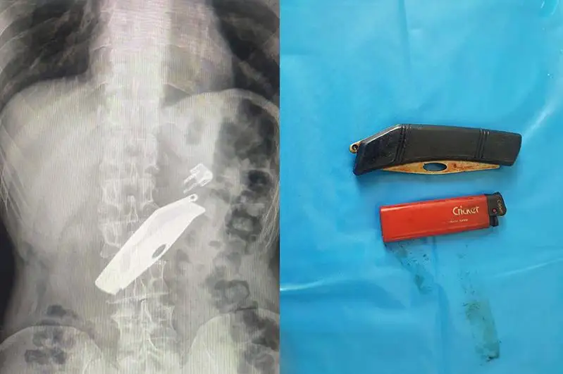 Складной нож и зажигалку проглотил мужчина в СКО
