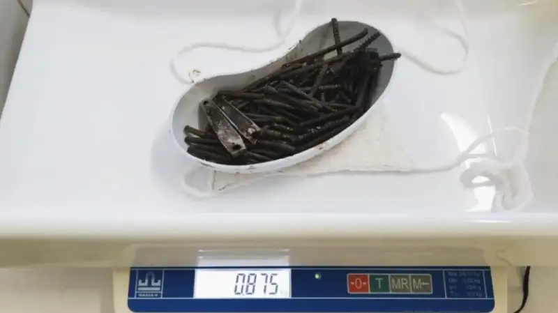 112 саморезов извлекли из желудка пациента акмолинские врачи