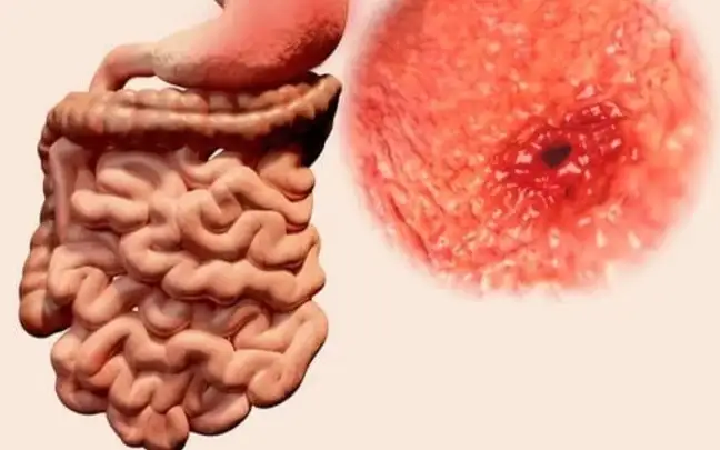 сибирская язва